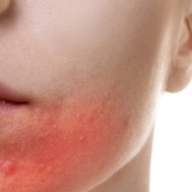 periorální dermatitida na obličeji